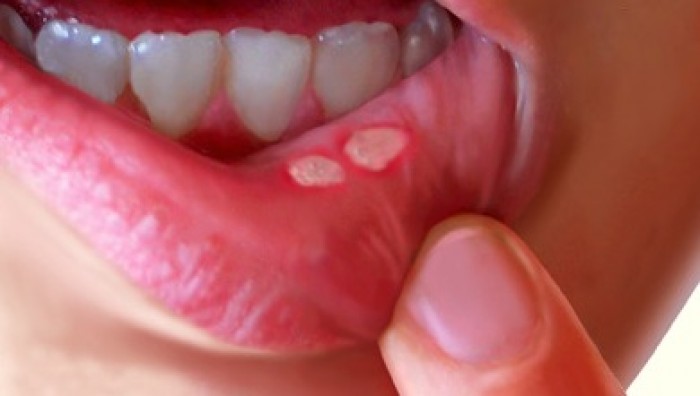 nhiệt miệng là gì,làm sao để chữa nhiệt miệng,nhiệt miệng,viêm loét niêm mạc miệng,vì sao bị nhiệt miệng,nguyên nhân của nhiệt miệng,cách chữa nhiệt miệng,bị nhiệt miệng phải làm sao,Loét aphthous,loét áp - tơ,Loét aphthous là gì,loét áp - tơ là gì