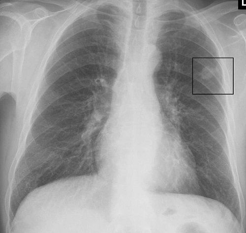 Ung thư là gì,Ung thư,bệnh ung thư là gì,bệnh ung thư,câu hỏi y học,cancer,what is cancer