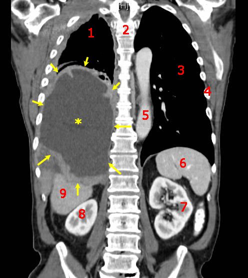 Ung thư là gì,Ung thư,bệnh ung thư là gì,bệnh ung thư,câu hỏi y học,cancer,what is cancer