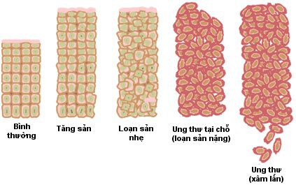 Ung thư là gì,Ung thư,bệnh ung thư là gì,bệnh ung thư,câu hỏi y học,cancer,what is cancer