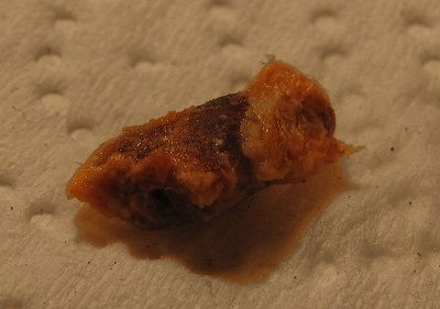 Ráy tai là gì,Vì sao lại có ráy tai,ráy tai,earwax,cerumen,ráy tai của người