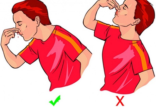 Chảy máu cam là gì,cách sơ cứu khi bị chảy máu cam,Khi chảy máu cam ta ngả đầu về phía trước hay phía sau,chảy máu cam có phải do thiếu vitamin C không,chảy máu cam phải làm sao,vì sao bị chảy máu cam,vì sao bị chảy máu cam,chảy máu cam có nguy hiểm không,cách phòng tránh chảy máu cam,phòng ngừa chảy máu cam,câu hỏi sức khỏe