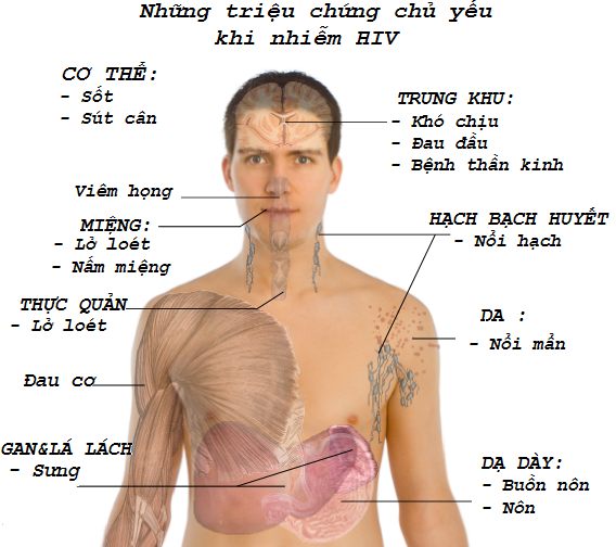 Những triệu chứng chính của giai đoạn nhiễm HIV cấp tính.